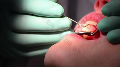 牙医检查口香糖牙龈炎疾病